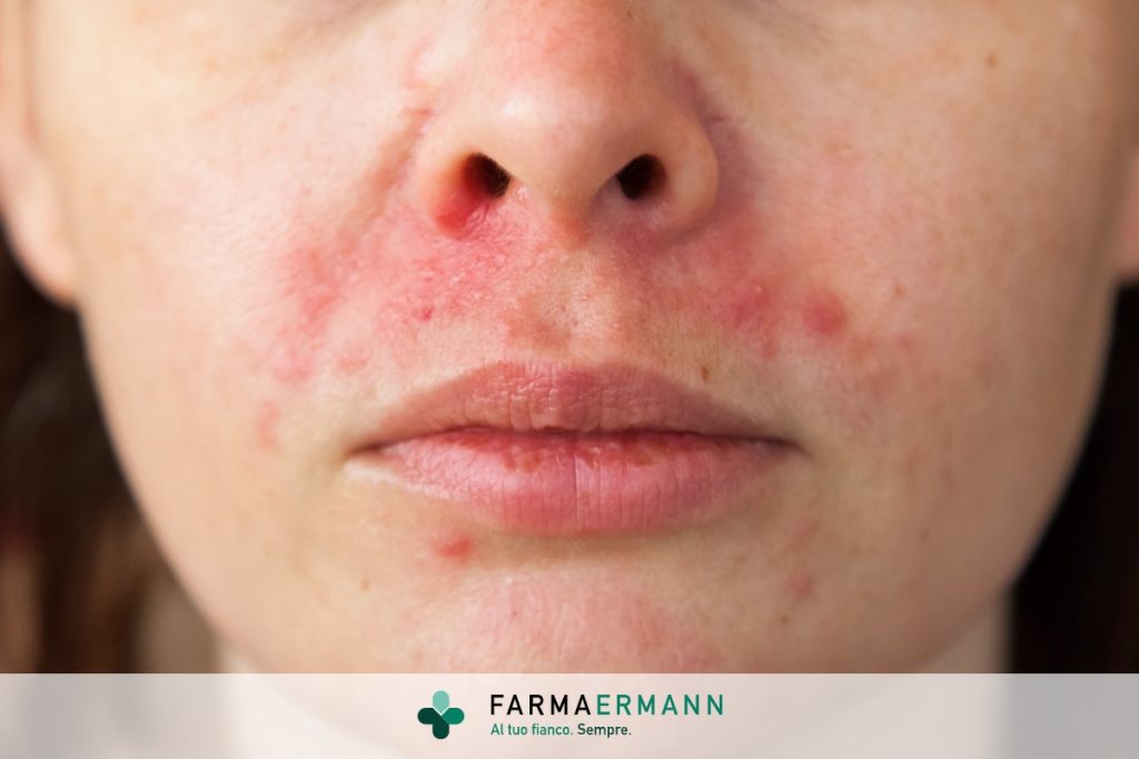 Come curare la dermatite seborroica al viso?