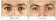 Teosyal PureSense Redensity II Filler intradermico occhiaie (2 siringhe da 1ml ciascuna)