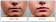 Teosyal PureSense Kiss Filler intradermico labbra (2 siringhe da 1ml ciascuna)
